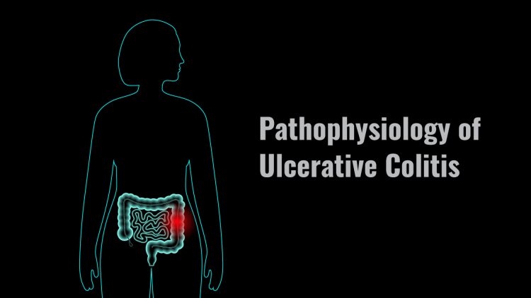 Ulcerative Colitis Pathophysiology Highcarbhealth