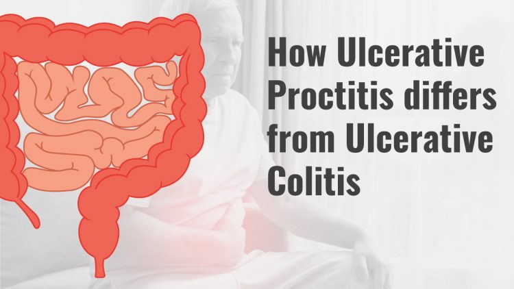 Ulcerative Proctitis Vs. Colitis: Causes, Symptoms, Treatment ...